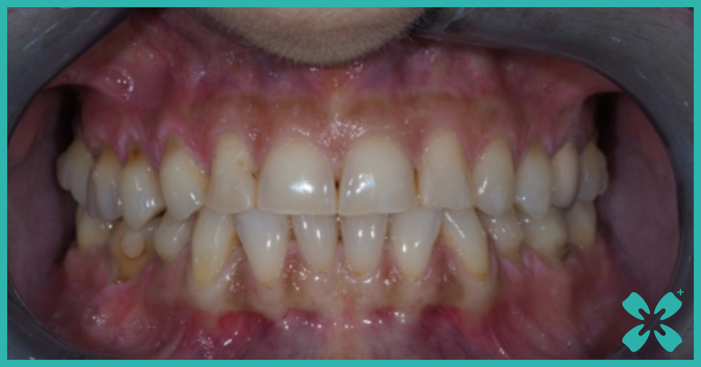 Foto caso clinico, denti primo appuntamento presso Studio Dentistico Insogna-Petullà