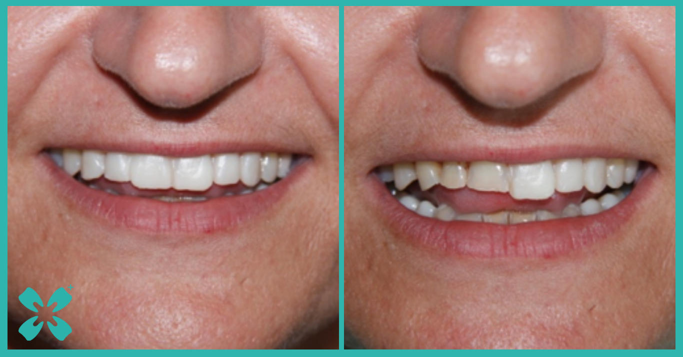 Foto scattate durante la prova del mock-up. La foto di dx riporta la differenza tra il mock-up e i denti.