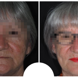 Due immagini a confronto della paziente: prima e dopo il percorso terapeutico